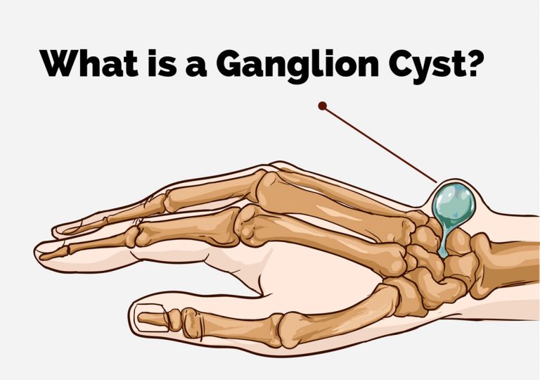 >Ganglion Cysts
